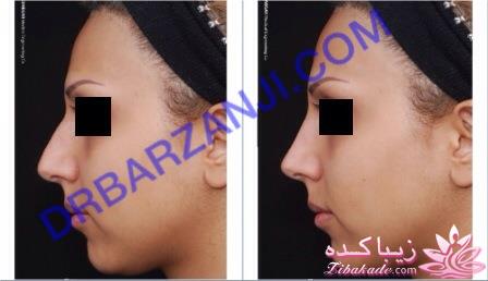 جراحی بینی - جراحی زیبایی